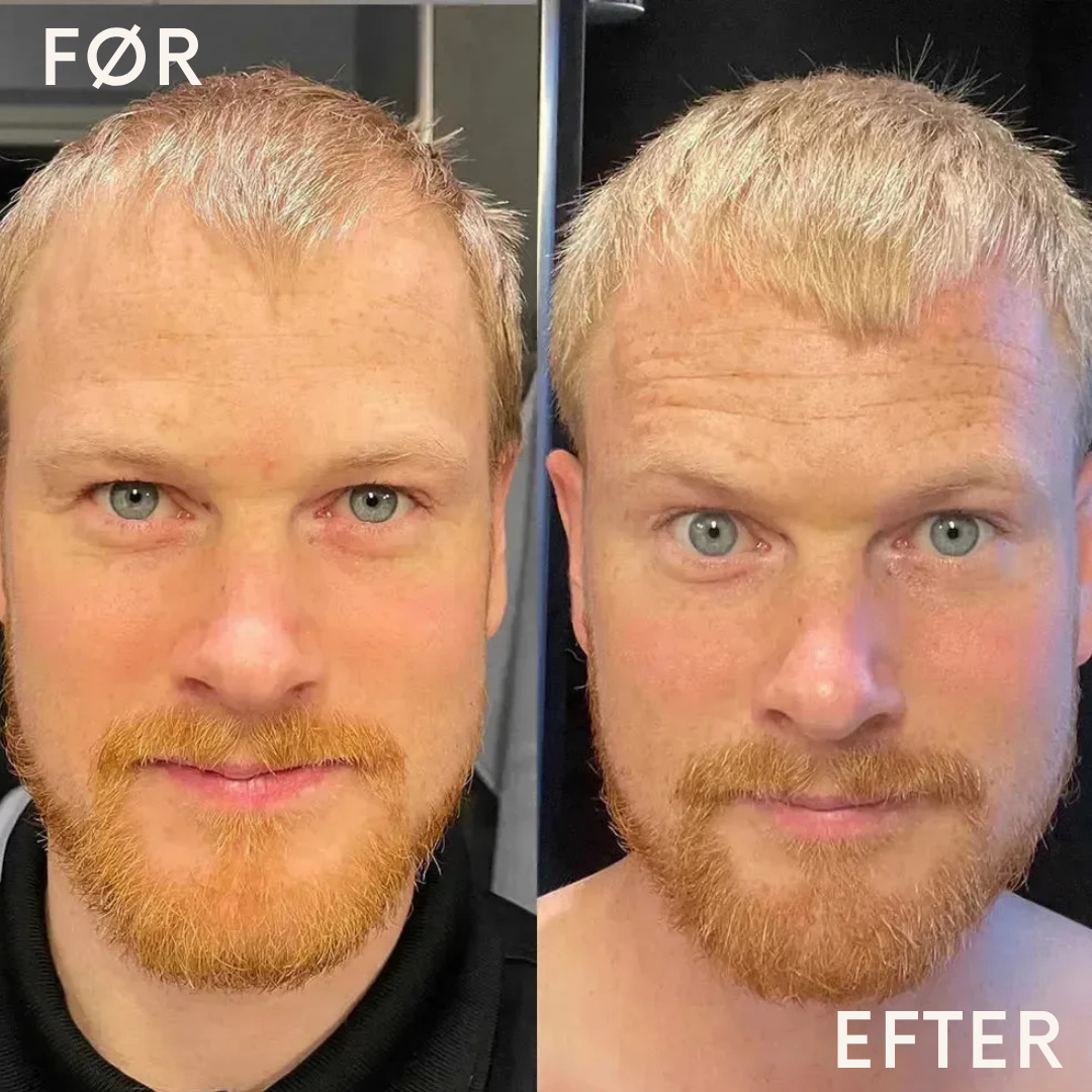 Bio Pilixin® Hårvækst Serum til Mænd