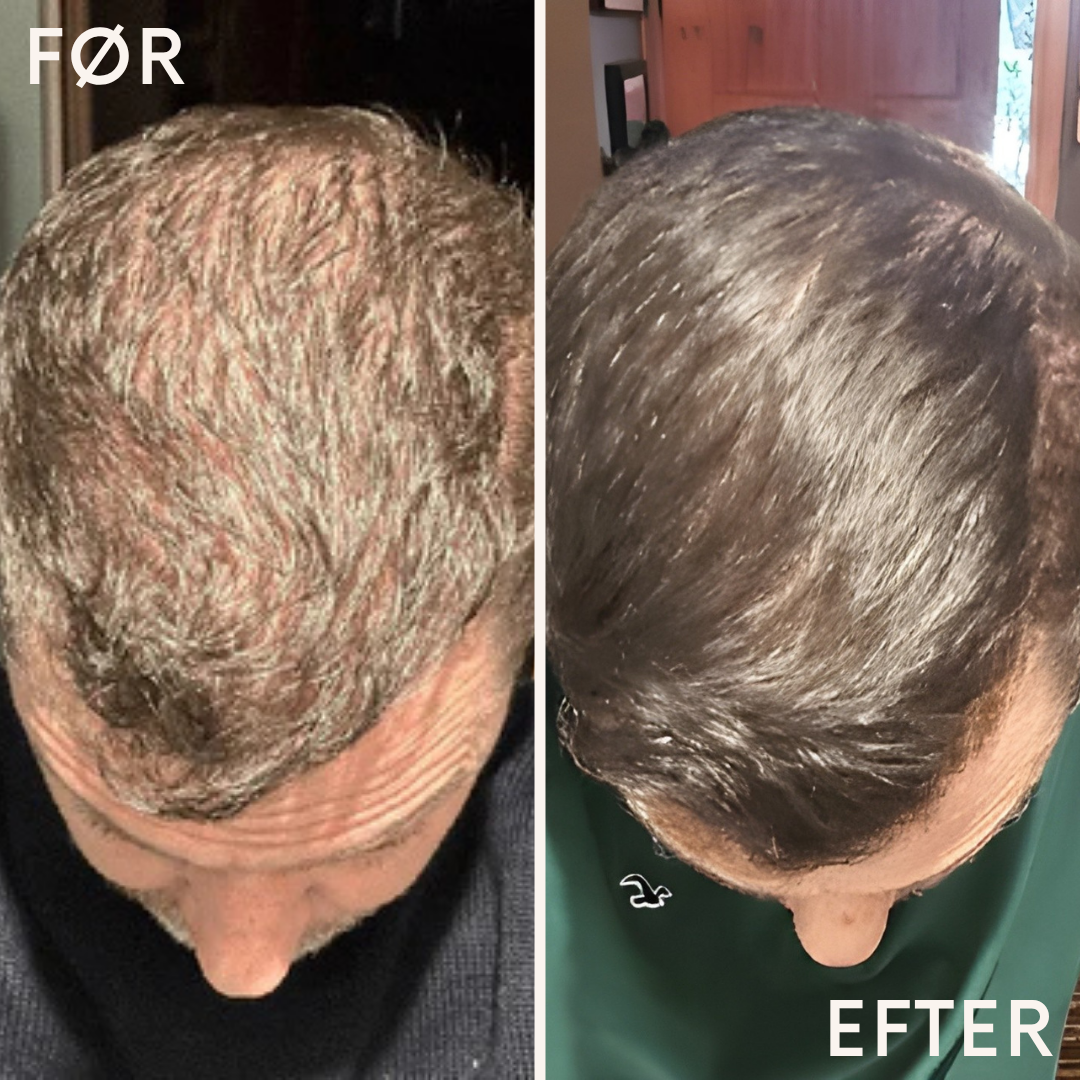 Bio Pilixin® Hårvækst Serum til Mænd